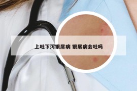 上吐下瀉銀屑病 銀屑病會(huì)吐嗎