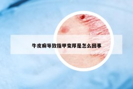 牛皮癬導(dǎo)致指甲變厚是怎么回事