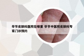 畢節(jié)皮膚科醫(yī)院在哪里 畢節(jié)中醫(yī)院皮膚科專家門診預(yù)約
