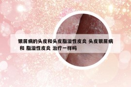 銀屑病的頭皮和頭皮脂溢性皮炎 頭皮銀屑病 和 脂溢性皮炎 治療一樣嗎