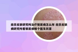 南京皮膚研究所治療銀屑病怎么樣 南京皮膚病研究所看銀屑病哪個醫(yī)生厲害