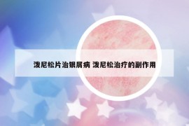 潑尼松片治銀屑病 潑尼松治療的副作用