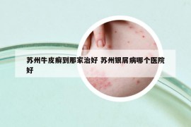 蘇州牛皮癬到那家治好 蘇州銀屑病哪個醫(yī)院好