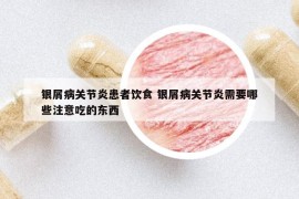 銀屑病關(guān)節(jié)炎患者飲食 銀屑病關(guān)節(jié)炎需要哪些注意吃的東西