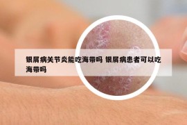銀屑病關(guān)節(jié)炎能吃海帶嗎 銀屑病患者可以吃海帶嗎