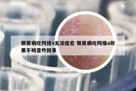 銀屑病吃阿維a無法痊愈 銀屑病吃阿維a效果不明顯咋回事