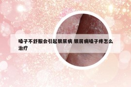 嗓子不舒服會引起銀屑病 銀屑病嗓子疼怎么治療