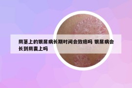 陰莖上的銀屑病長期時間會致癌嗎 銀屑病會長到陰囊上嗎