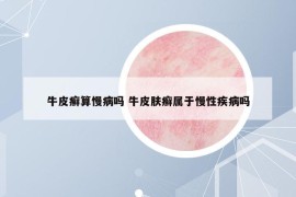 牛皮癬算慢病嗎 牛皮膚癬屬于慢性疾病嗎
