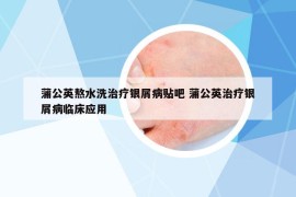 蒲公英熬水洗治療銀屑病貼吧 蒲公英治療銀屑病臨床應(yīng)用