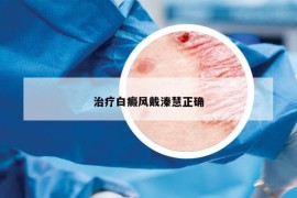 治療白癜風(fēng)戴溱慧正確