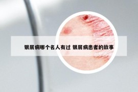 銀屑病哪個名人有過 銀屑病患者的故事