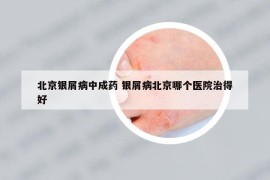北京銀屑病中成藥 銀屑病北京哪個(gè)醫(yī)院治得好