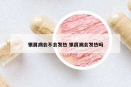 銀屑病會不會發(fā)熱 銀屑病會發(fā)熱嗎