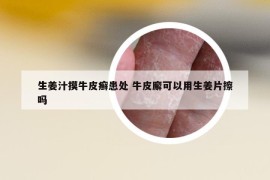 生姜汁摸牛皮癬患處 牛皮廨可以用生姜片擦嗎