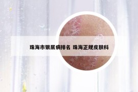 珠海市銀屑病排名 珠海正規(guī)皮膚科