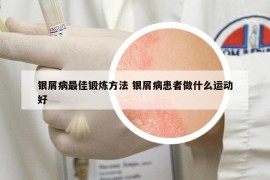 銀屑病最佳鍛煉方法 銀屑病患者做什么運動好