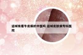 運(yùn)城有看牛皮癬的中醫(yī)嗎 運(yùn)城皮膚病專科醫(yī)院