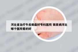 河北省治療牛皮癬最好專科醫(yī)院 銀屑病河北哪個醫(yī)院看的好