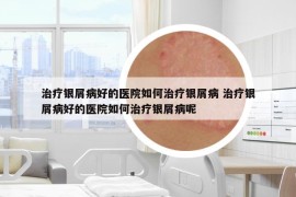 治療銀屑病好的醫(yī)院如何治療銀屑病 治療銀屑病好的醫(yī)院如何治療銀屑病呢