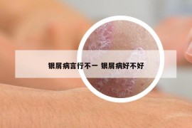 銀屑病言行不一 銀屑病好不好