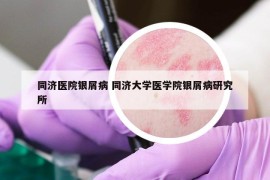 同濟醫(yī)院銀屑病 同濟大學(xué)醫(yī)學(xué)院銀屑病研究所