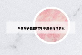 牛皮癬再慢慢好轉(zhuǎn) 牛皮癬好轉(zhuǎn)情況