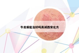 牛皮癬能治好嗎真誠(chéng)西安北方