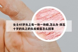 女士45歲頭上有一塊一塊癬,怎么辦 四五十歲的頭上的頭皮癬是怎么回事