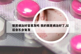 銀屑病治好容易發(fā)嗎 我的銀屑病治好了,以后會不會復(fù)發(fā)