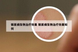 銀屑病生物治療效果 銀屑病生物治療效果如何