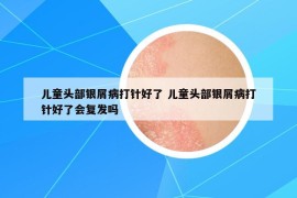 兒童頭部銀屑病打針好了 兒童頭部銀屑病打針好了會復(fù)發(fā)嗎