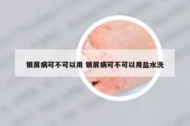 銀屑病可不可以用 銀屑病可不可以用鹽水洗