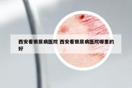 西安看銀屑病醫(yī)院 西安看銀屑病醫(yī)院哪里的好