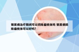 銀屑病治療期間可以切除扁桃體媽 銀屑病摘除扁桃體可以好嗎?