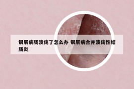 銀屑病腸潰瘍了怎么辦 銀屑病合并潰瘍性結(jié)腸炎