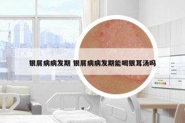 銀屑病病發(fā)期 銀屑病病發(fā)期能喝銀耳湯嗎