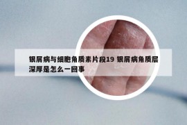 銀屑病與細(xì)胞角質(zhì)素片段19 銀屑病角質(zhì)層深厚是怎么一回事