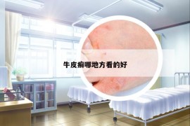 牛皮癬哪地方看的好