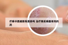 療癬卡西甫散有激素嗎 治療銀皮癬最有效的藥