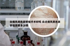 白癜風(fēng)黑色素移植手術(shù)好嗎 白點癲風(fēng)黑色素移植需要多少錢