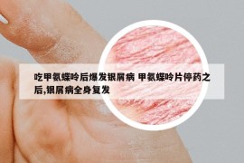 吃甲氨蝶呤后爆發(fā)銀屑病 甲氨蝶呤片停藥之后,銀屑病全身復發(fā)
