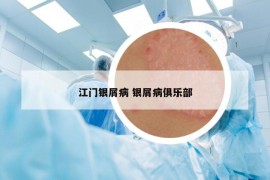 江門(mén)銀屑病 銀屑病俱樂(lè)部