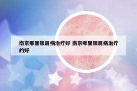 南京那里銀屑病治療好 南京哪里銀屑病治療的好