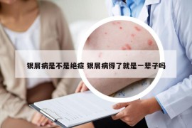 銀屑病是不是絕癥 銀屑病得了就是一輩子嗎