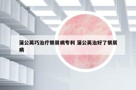 蒲公英巧治療銀屑病專利 蒲公英治好了銀屑病