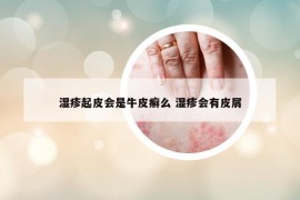 濕疹起皮會(huì)是牛皮癬么 濕疹會(huì)有皮屑