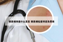 銀屑病待查什么意思 銀屑病檢查項(xiàng)目及費(fèi)用