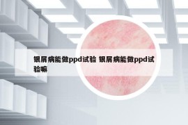 銀屑病能做ppd試驗(yàn) 銀屑病能做ppd試驗(yàn)嘛