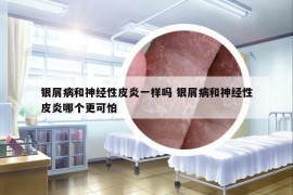 銀屑病和神經(jīng)性皮炎一樣嗎 銀屑病和神經(jīng)性皮炎哪個更可怕